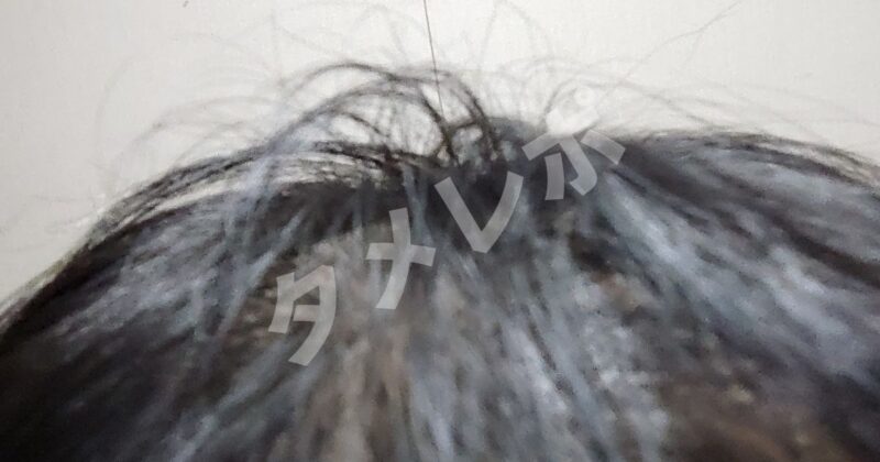 中年男の頭皮画像　薄毛　ハゲ