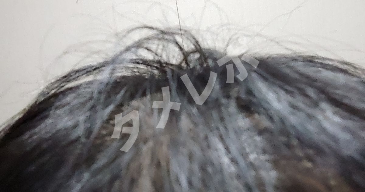 中年男の頭皮画像 薄毛 ハゲ